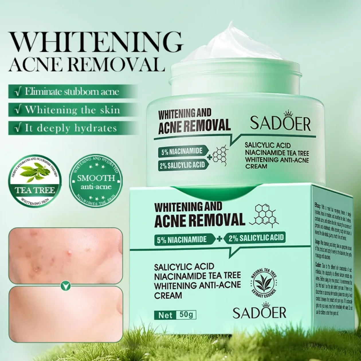 Anti-Acne Whitening Cream with Niacinamide